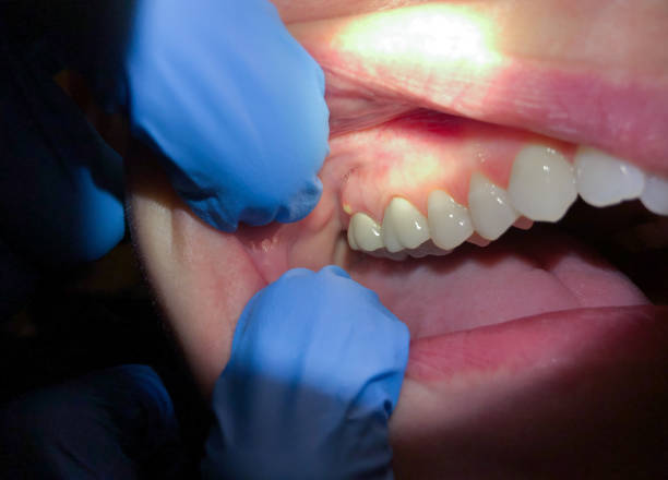 Best Emergency Broken Tooth Repair in Park Center, CO